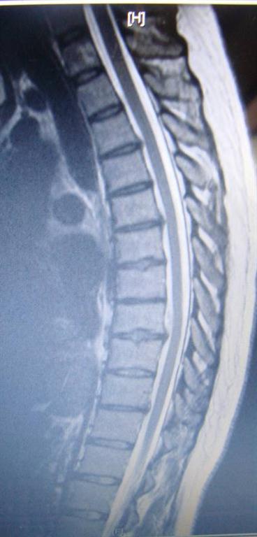 thoracic disc herniation treated by Richmond chiropractor